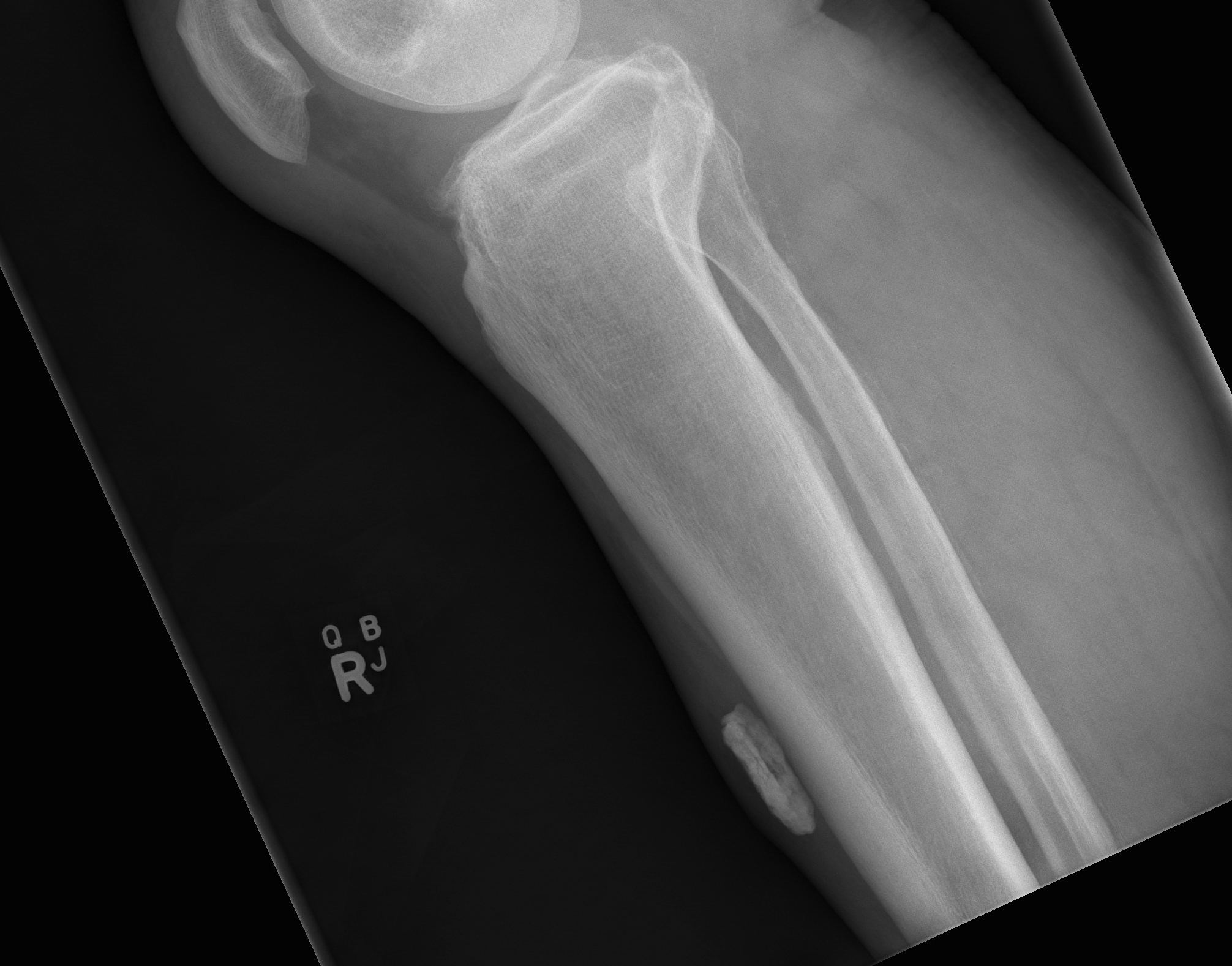 Tibial Myositis Ossificans